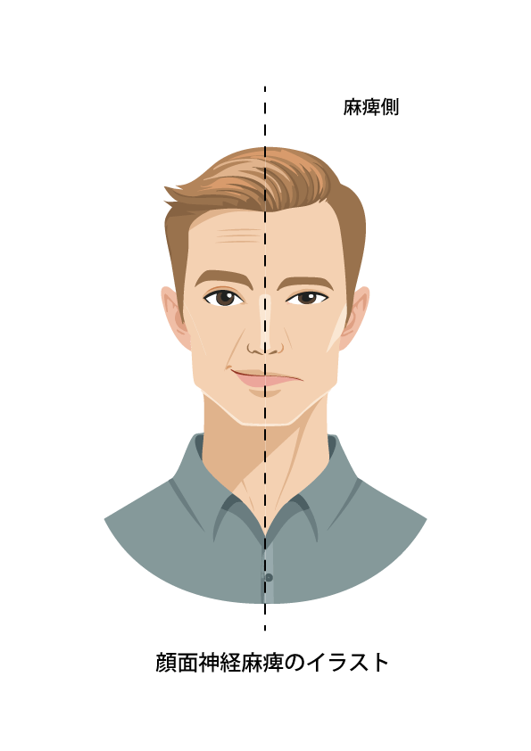 顔面神経麻痺のイラスト